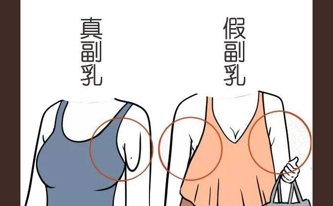 多乳癥是什么癥狀？