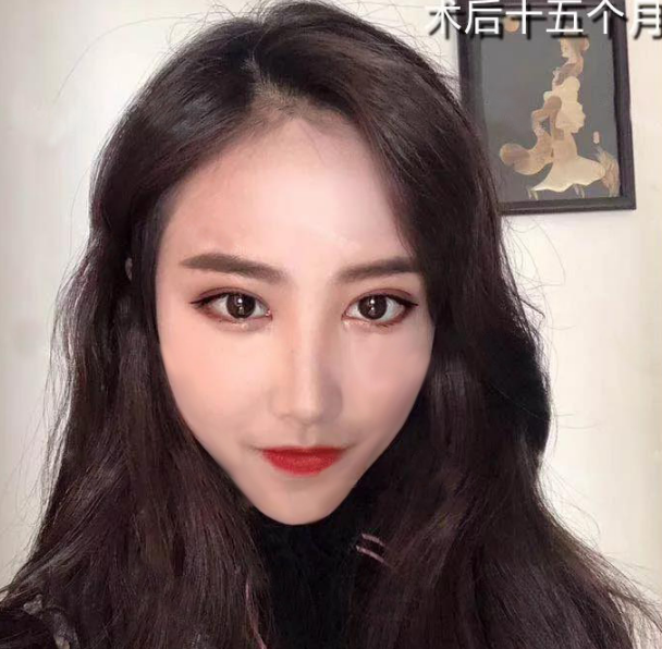 微創(chuàng)雙眼皮術后十五個月效果
