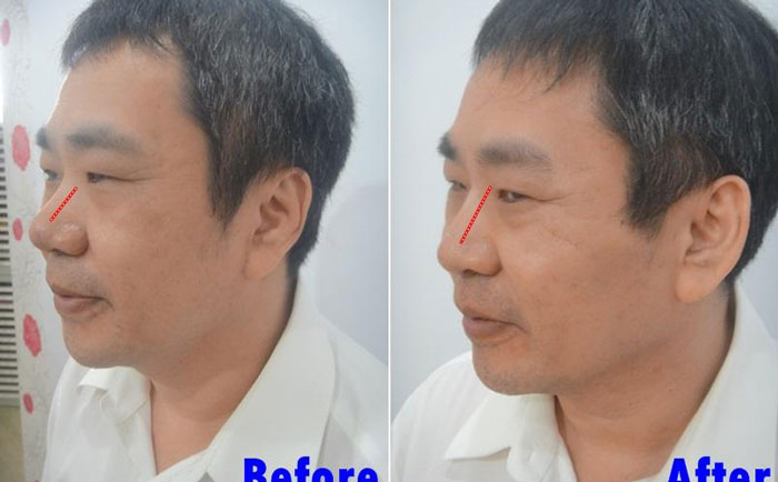 男性隆鼻子大概多少錢？