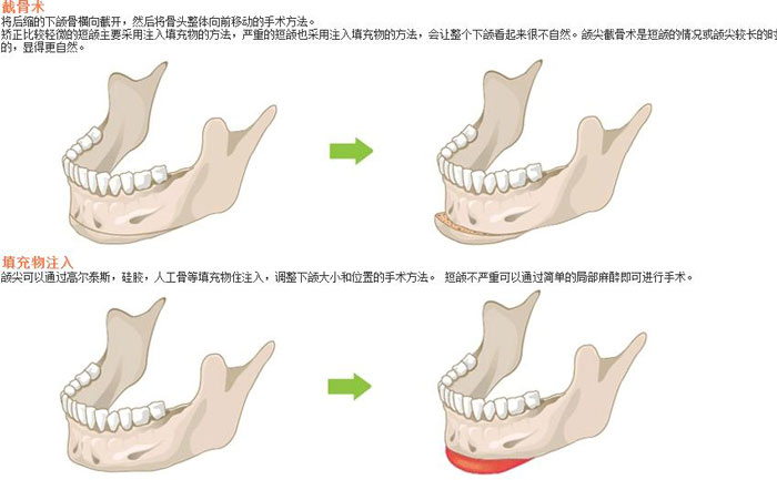 下頜角切除術(shù)一般多少錢(qián)？下頜角切除有后遺癥嗎？