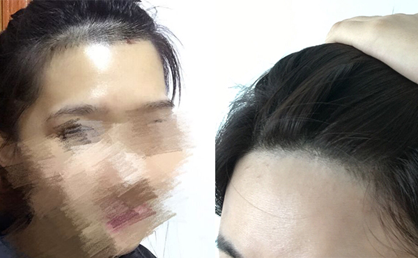 冰點(diǎn)面部脫毛有沒有疼痛感？