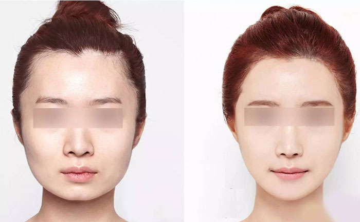 臉部咬肌肥大怎么瘦？臉部咬肌肥大如何去除？