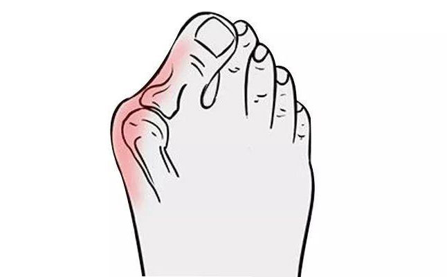 大腳骨矯正手術(shù)多少錢？大腳骨矯正三個(gè)月可以恢復(fù)嗎？