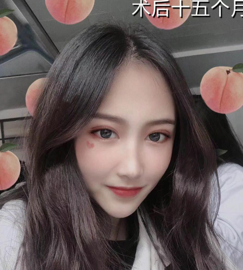 微創(chuàng)雙眼皮術后十五個月效果