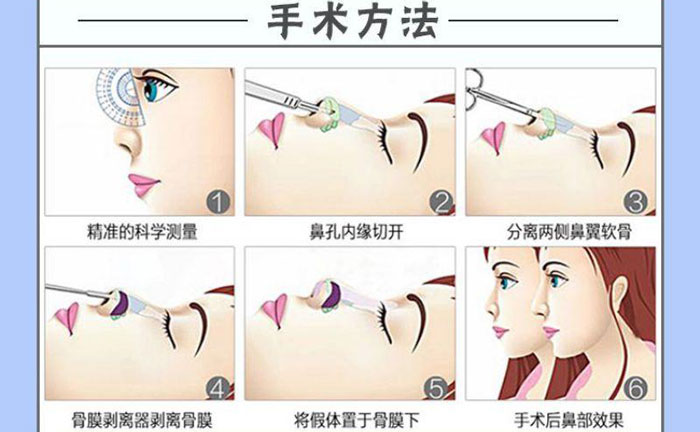 隆鼻假體取出后能恢復(fù)到以前嗎？