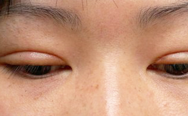 埋線雙眼皮失敗該如何修復(fù)？多久修復(fù)好？