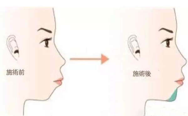 注射愛(ài)貝芙墊下巴多少錢?有什么特點(diǎn)?