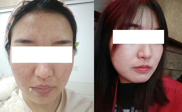 美白針可以維持多久？