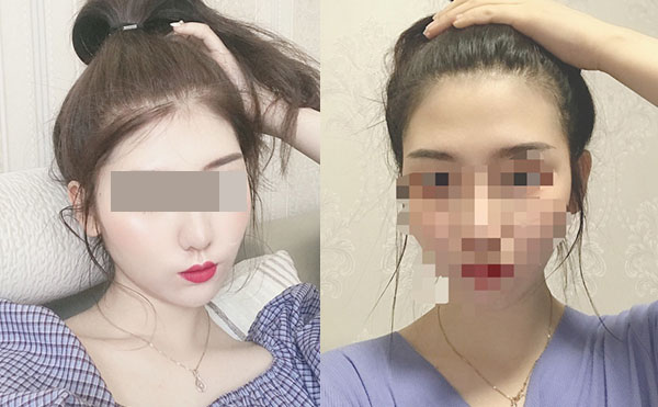 冰點(diǎn)脫毛后多久可以洗澡嗎？