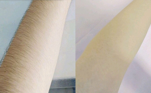 光子脫毛有疼痛感嗎？