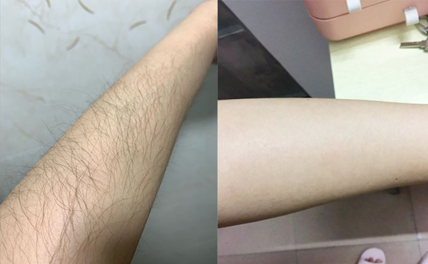 光子手臂脫毛是怎么做的？
