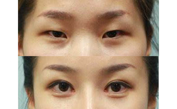 眼綜合手術(shù)多久能恢復自然？