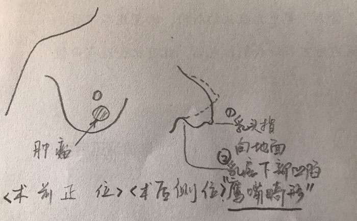 乳房畸形是什么原因造成的？乳房畸形矯正手術(shù)方法？