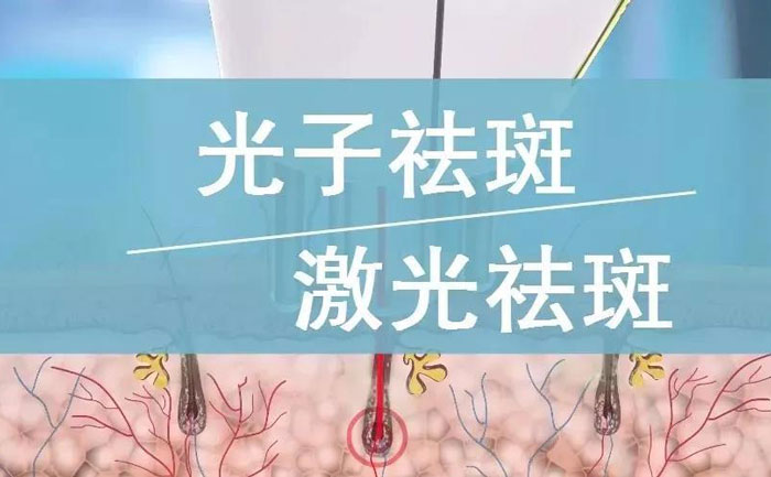 光子祛斑效果如何？
