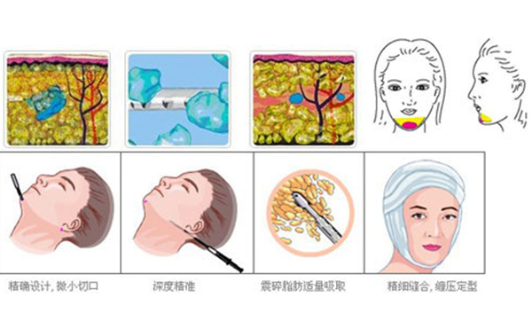 下巴整形吸脂術(shù)要多少錢？