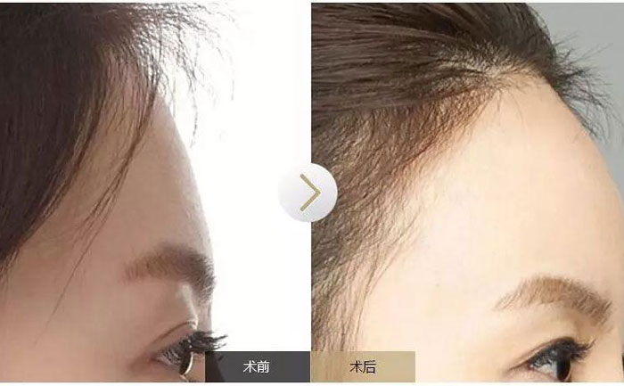 額頭填充術(shù)可以保持多久？