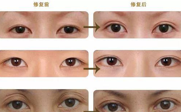 雙眼皮修復(fù)可靠嗎？什么時(shí)候做雙眼皮修復(fù)比較好？