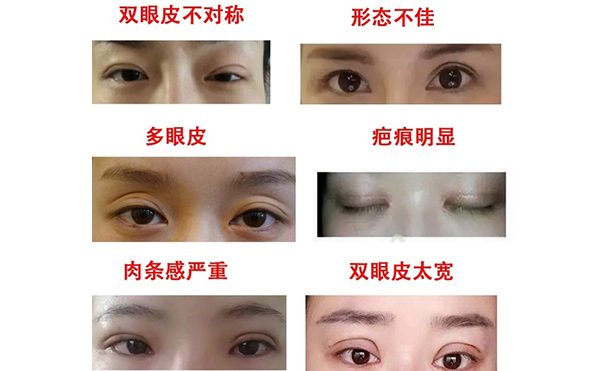 哪些情況需做雙眼皮修復(fù)？修復(fù)難度大不大?