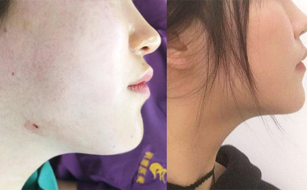 面部吸脂恢復(fù)期多長時(shí)間？