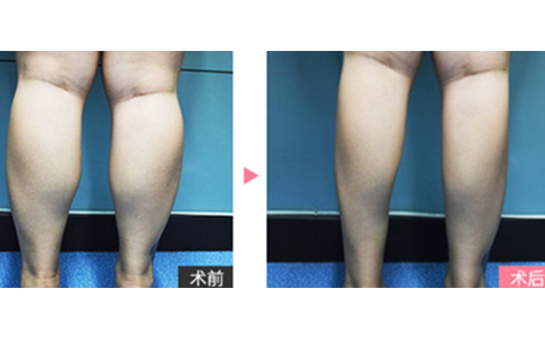 boxo瘦腿有什么優(yōu)勢？