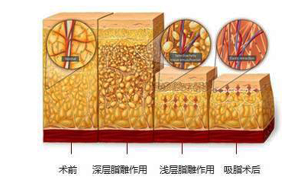 韓式分層吸脂的效果怎么樣？
