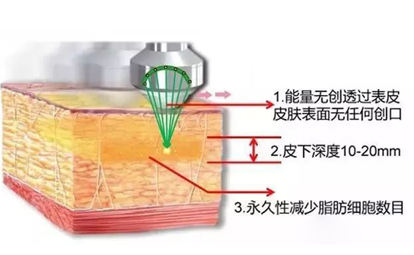 超聲波吸脂怎么瘦手臂？
