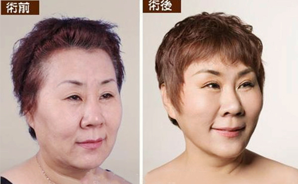 拉皮手術(shù)多久能恢復自然？