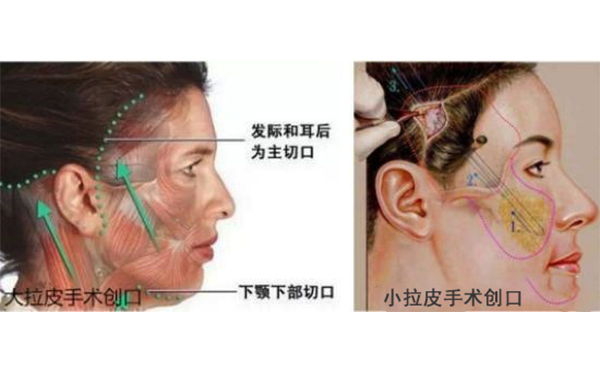 小拉皮和傳統(tǒng)拉皮有什么區(qū)別？