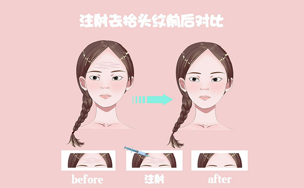 電波拉皮怎么去除抬頭紋？