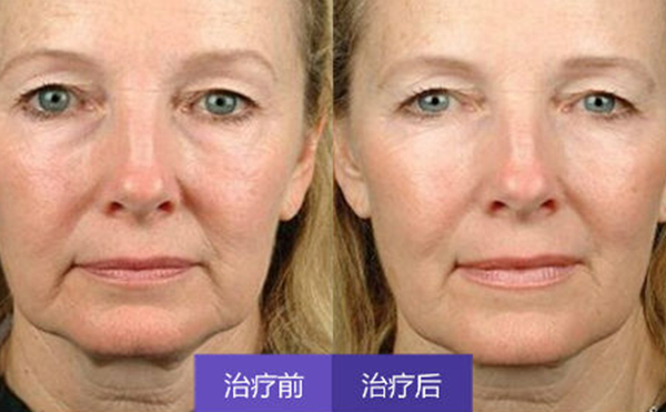 激光除皺有副作用嗎?術后怎么護理?