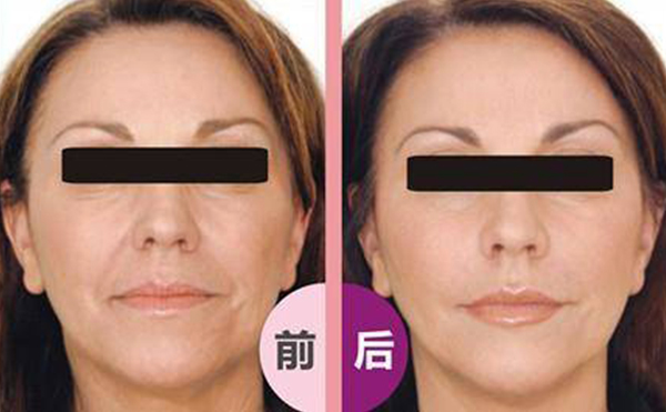 激光除皺會(huì)反彈嗎？