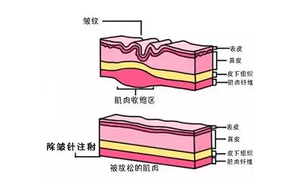 注射除皺是什么原理？