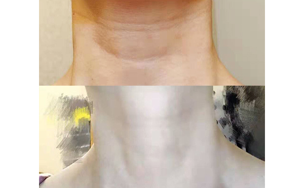 嗨體可以長期使用嗎？