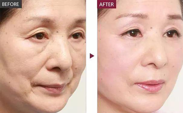 膠原蛋白除皺的適應(yīng)人群？