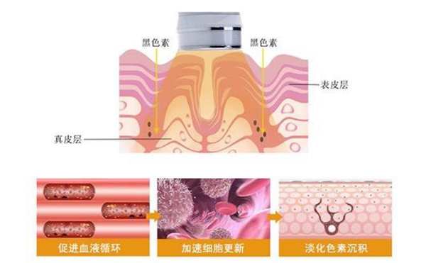 光子嫩膚效果好不好？