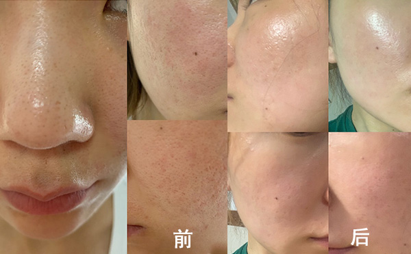 無針水光有什么優(yōu)勢？