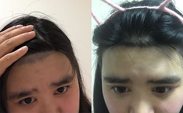 激光脫毛安全嗎？