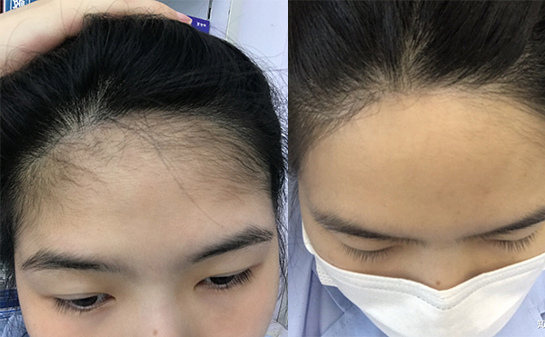 激光脫發(fā)際線的過(guò)程是什么？