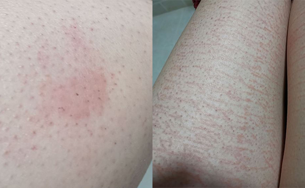 錯誤脫毛有什么后果？
