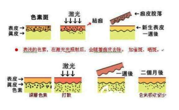 光子嫩膚和皮秒有什么區(qū)別？