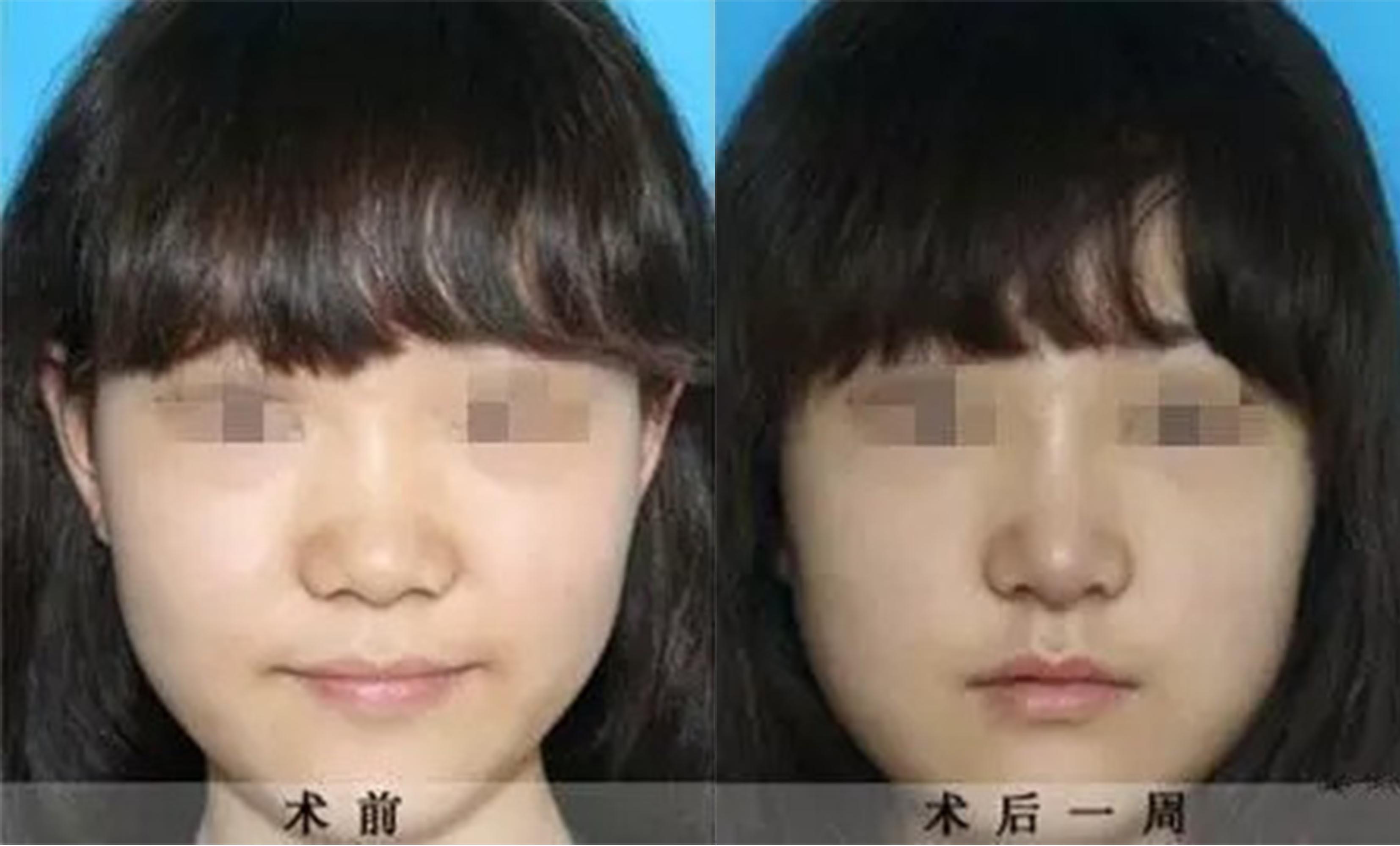 鼻頭、鼻翼縮小