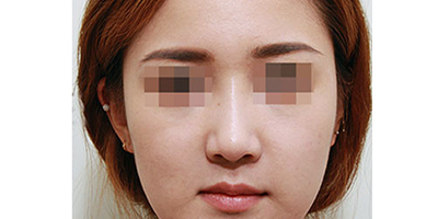 寬鼻矯正術后
