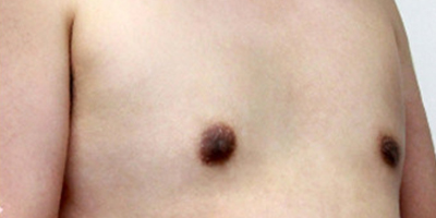 男性乳房肥大矯正術后