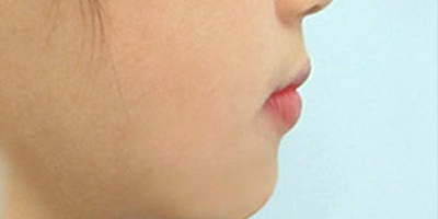 隱形矯正術后