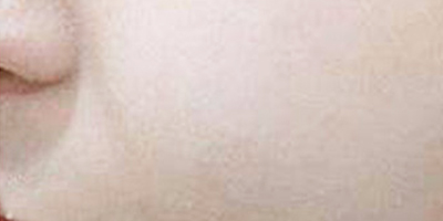 美白導入術(shù)后