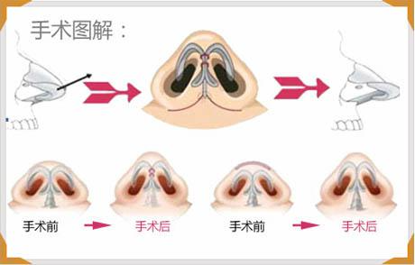 縮鼻頭手術(shù)可以保持多久？縮鼻頭手術(shù)術(shù)后注意事項？