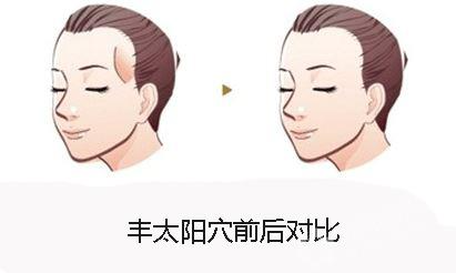 什么是自體脂肪豐太陽穴？用自體脂肪豐太陽穴的效果能維持多久？