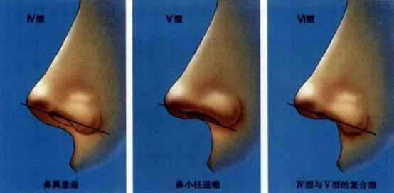 鼻小柱延長術(shù)一般價位多少錢？做鼻小柱延長術(shù)有什么不好的影響嗎？