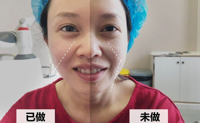 激光溶脂瘦臉的副作用及效果？光纖溶脂瘦臉多久可以見(jiàn)效？