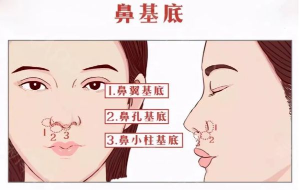 自體脂肪填充鼻基底好不好？鼻基底脂肪填充多久恢復(fù)？